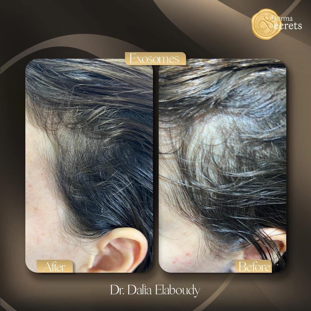Hair exosomes results