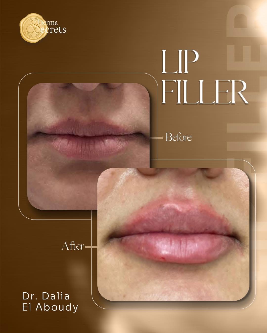 Lip filler before & after