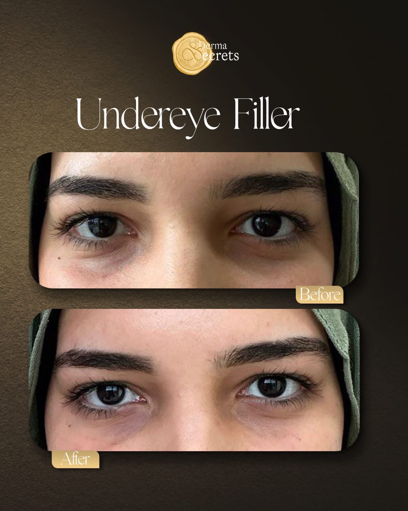 Undereye filler before & after